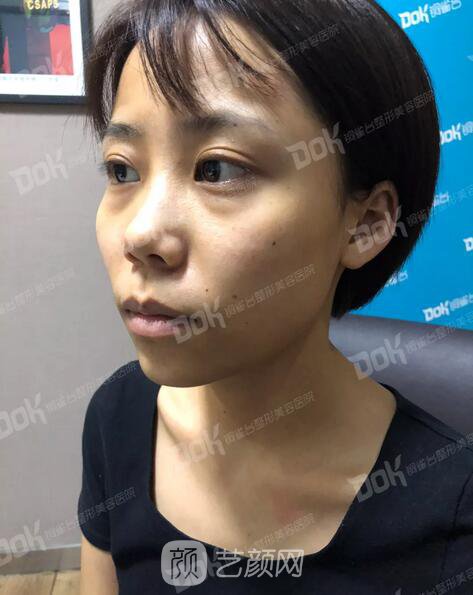 內(nèi)切祛眼袋果怎么樣？來(lái)瞧瞧這些照片就可能會(huì)有答案了哦~