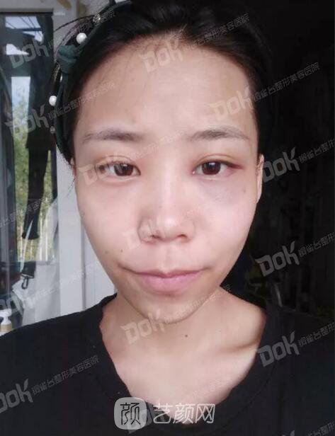 內(nèi)切祛眼袋果怎么樣？來(lái)瞧瞧這些照片就可能會(huì)有答案了哦~