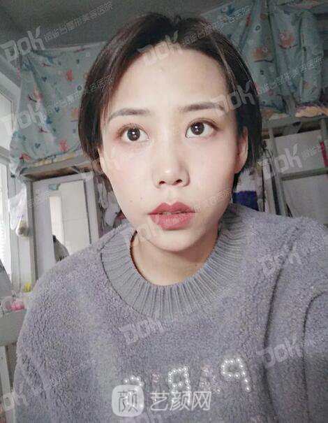 內(nèi)切祛眼袋果怎么樣？來(lái)瞧瞧這些照片就可能會(huì)有答案了哦~