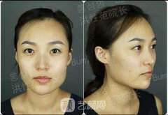 上海首爾麗格洪性范長曲線下頜角截骨+顴骨內(nèi)推真實(shí)案例