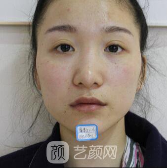 韓式翹鼻-真人案例，直呼我是混血兒