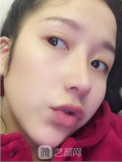 韓式翹鼻-真人案例，直呼我是混血兒