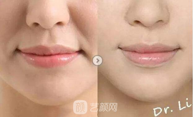 北京伊美康自體脂肪填充術(shù)后果