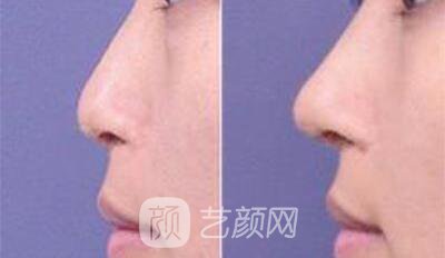 看我的韓式鼻子整形對照圖
