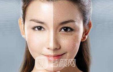 沒有斑 男票再也不會嫌棄我了