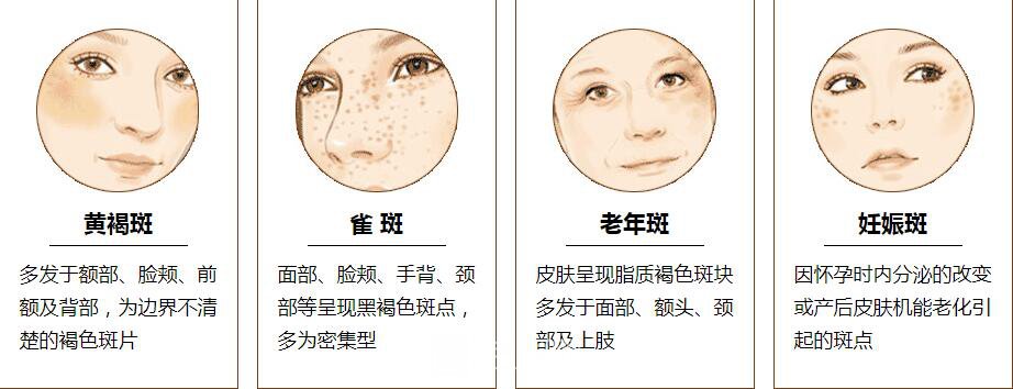 祛斑后不用化妝，我也可以一樣美麗。