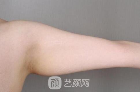 第一次去整形，做了上臂吸脂，自我感覺果很好哈哈