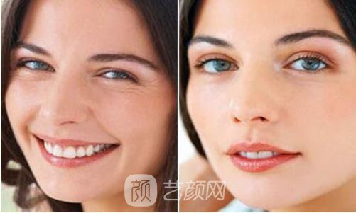 自體脂肪填充童顏術(shù),讓我也逆生長了一回