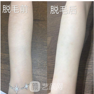 深圳翠綠寶石激光脫毛如何？我們一起來了解一下