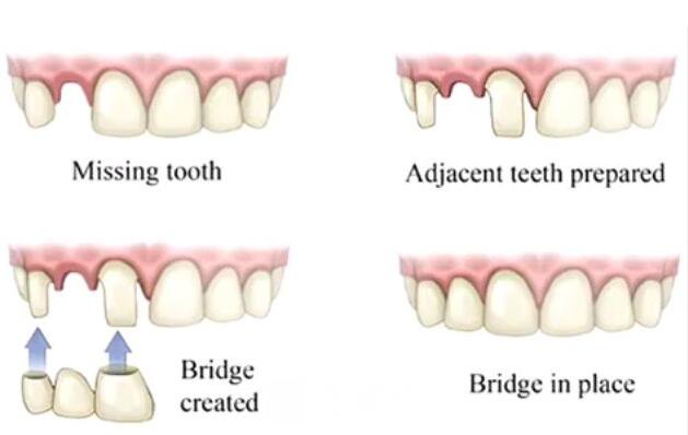做容冠，牙齒整齊又漂亮~