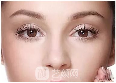 做完雙眼皮兩個(gè)月，簡(jiǎn)直跟換了個(gè)人似的