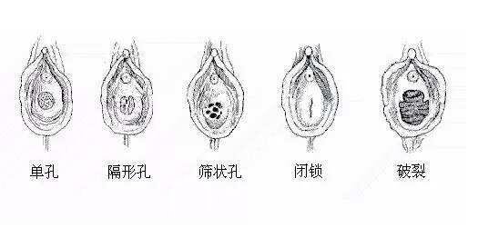 阜新修復(fù)處女膜哪好?