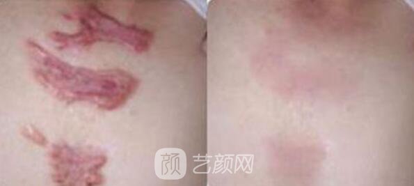 廣州曙光美容醫(yī)院疤痕專(zhuān)家怎樣