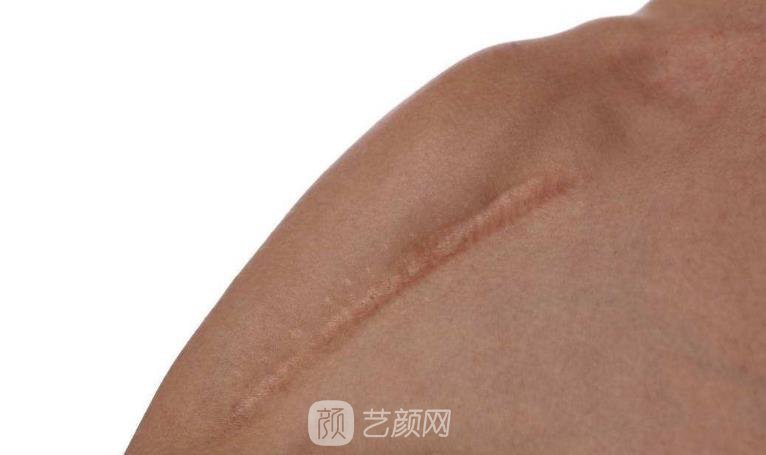 杭州激光去疤費用，多久見