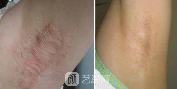 杭州激光去疤費用，多久見