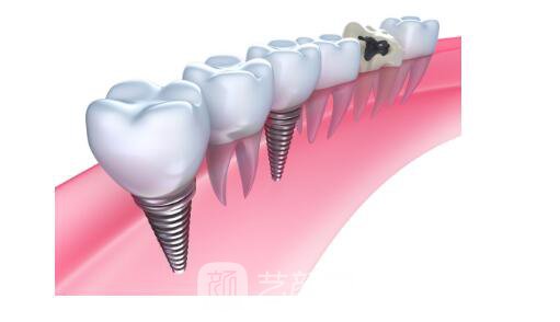衡陽(yáng)市牙齒整形選哪家醫(yī)院好