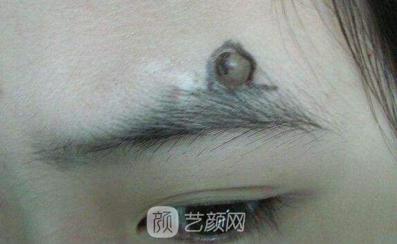 西安那里去痣更好，讓我這個(gè)專業(yè)醫(yī)生來告訴你