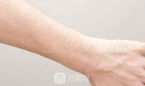 成都地區(qū)激光脫毛的價格是多少？