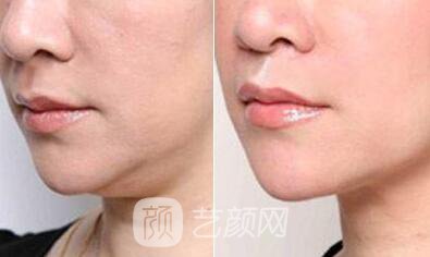 上海溶脂價格為什么沒有統(tǒng)一，當(dāng)?shù)爻錾t(yī)生為你解答