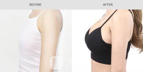 隆胸假體選擇哪種果好?我們一一來(lái)了解一下