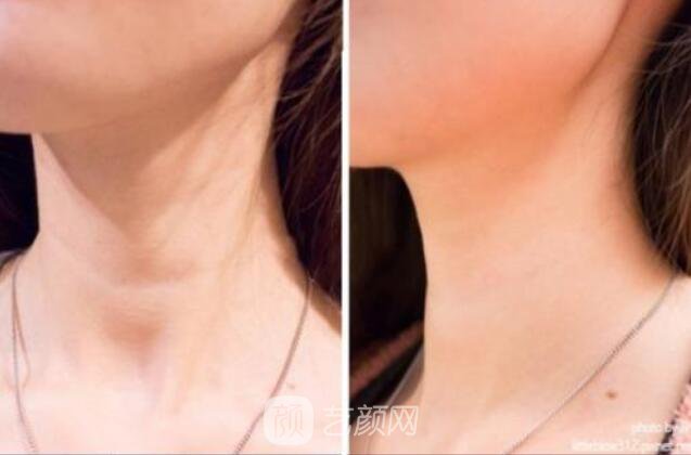 超聲提拉讓你重返年輕，美的無(wú)憂無(wú)慮!