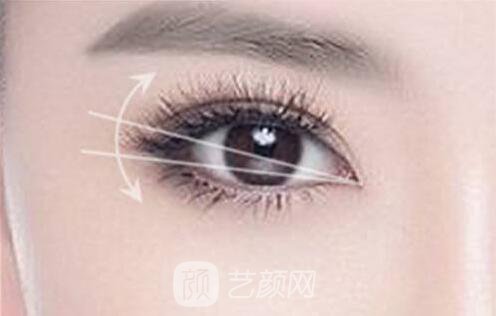 韓式切開雙眼皮的真實過程及恢復(fù)體驗分享~~