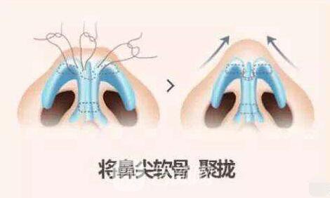隆鼻果出來了朋友們都說好，大家如何看呢？
