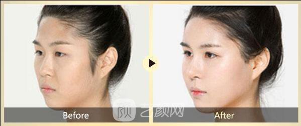 面部去皺術(shù)有很多，選適合自己的才是王道