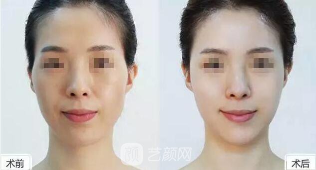 面部填充+隆鼻 變形記為你展示