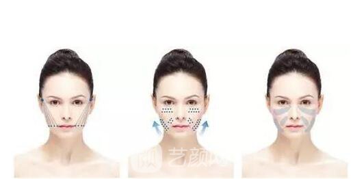 埋線提升提升能保持多久要看你術(shù)后的保養(yǎng)哦