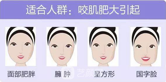 打注射瘦臉后臉真變小了，看來注射瘦臉真如傳聞所言