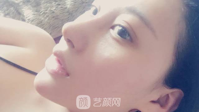 打注射瘦臉后臉真變小了，看來注射瘦臉真如傳聞所言