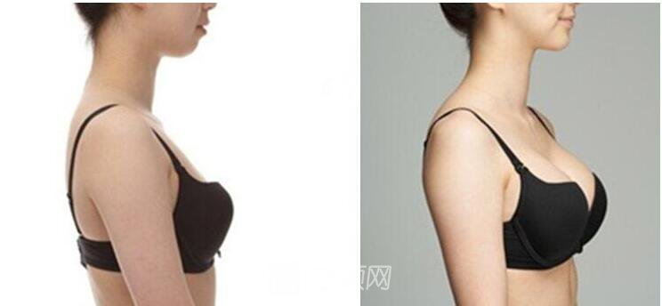 假體隆胸成就我的辣媽夢！