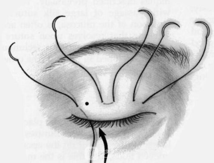 雙眼皮的恢復與外界影響有關(guān)嗎？