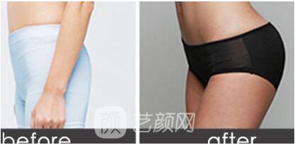 重慶埋線減肥怎么樣？