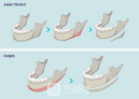 西昌整形專家湯穎峰：如何減少腮腺和頜下腺肥大？