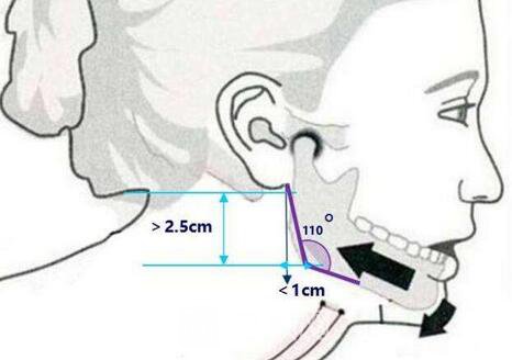 西昌整形專家湯穎峰：如何減少腮腺和頜下腺肥大？
