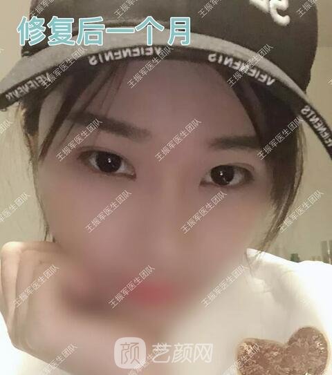 修復(fù)術(shù)后一個(gè)月果圖