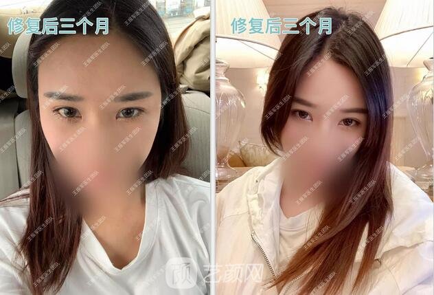 修復(fù)術(shù)后三個(gè)月果圖