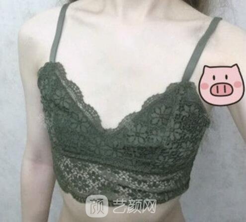 假體隆胸術(shù)前照