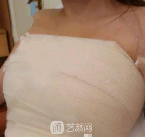 假體隆胸恢復(fù)期照片