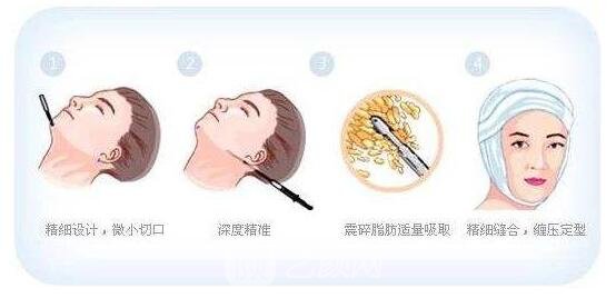 所謂面部吸脂手術(shù)，需要醫(yī)生在手術(shù)前根據(jù)患者自身面部比例的情況