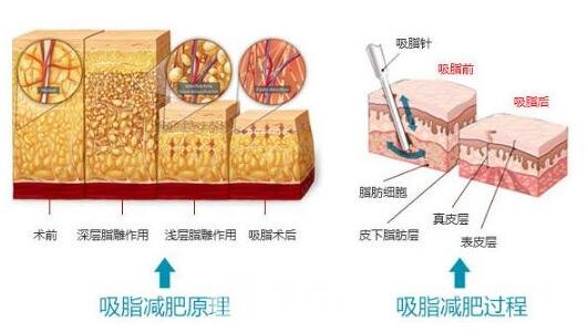 抽脂后應(yīng)定期口服一些抗生素以防止感染
