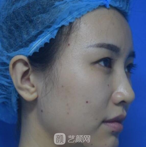 自體脂肪填充術(shù)前照片