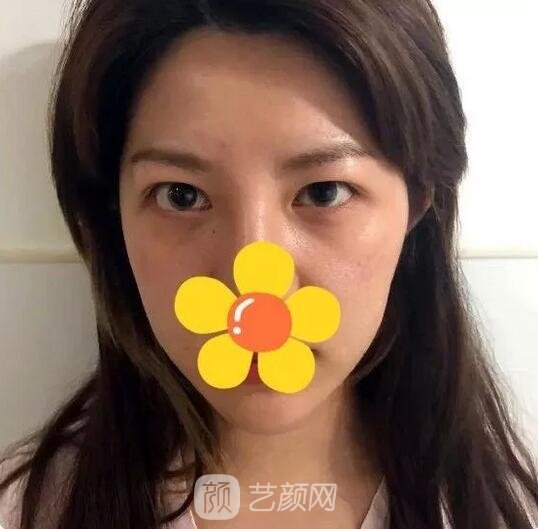 雙眼皮手術(shù)術(shù)前額頭扁平蘋果肌凹陷內(nèi)雙