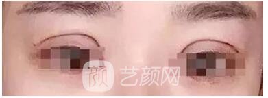 雙眼皮過(guò)寬