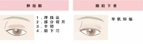 常見(jiàn)的雙眼皮形態(tài)