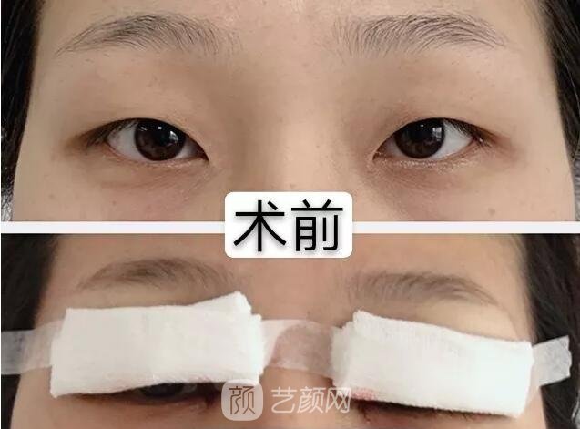 陳煥然雙眼皮案例