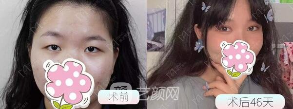 全切雙眼皮+開內(nèi)眼角手術(shù)案例