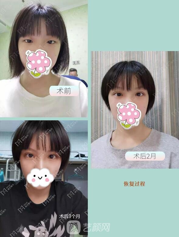 全切雙眼皮+開內(nèi)眼角